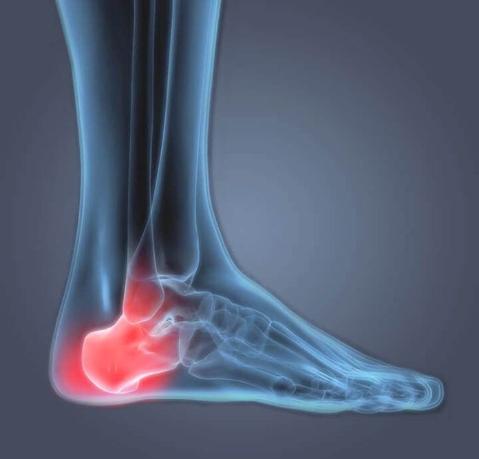 Are you having heel pain or bone spur in the heel or plantar fasciitis ...