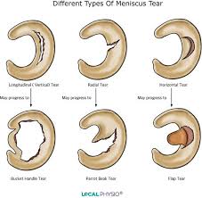 How to treat torn Meniscus ?