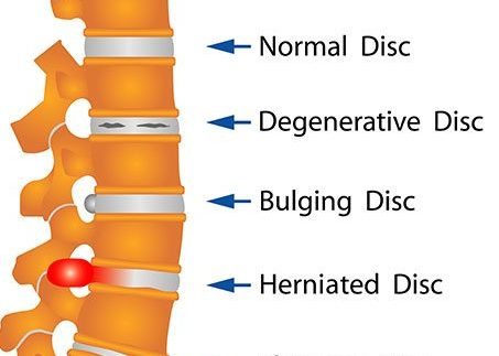 साइटिका का इलाज कैसे करे ?( sciatica  ka ilaz kaise kare ?)