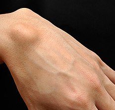 dorsal wrist ganglion